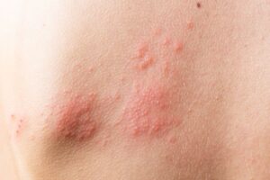 Radiodermite