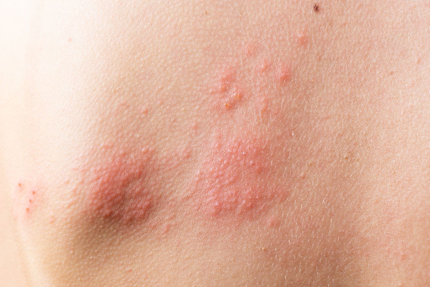 Radiodermite