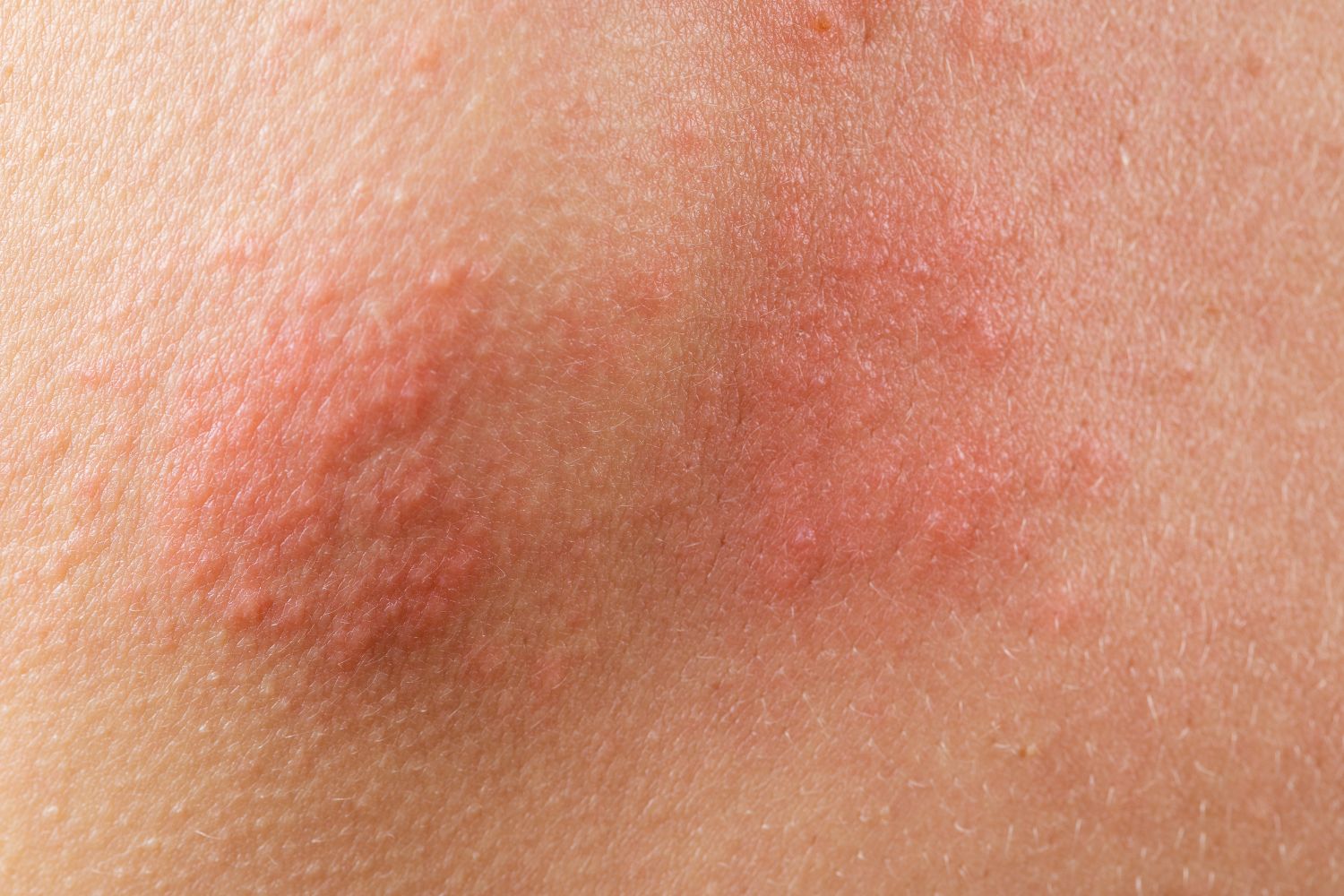 Rash cutaneo